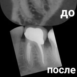 Лечение каналов зуба под микроскопом