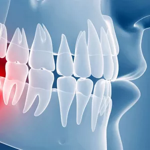 Безболезненное удаление зубов мудрости в Черкассах